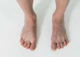 Renforcement du pied: Orteils en éventail