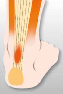 Sportverletzungen: Sehnen-Ansatzreizung